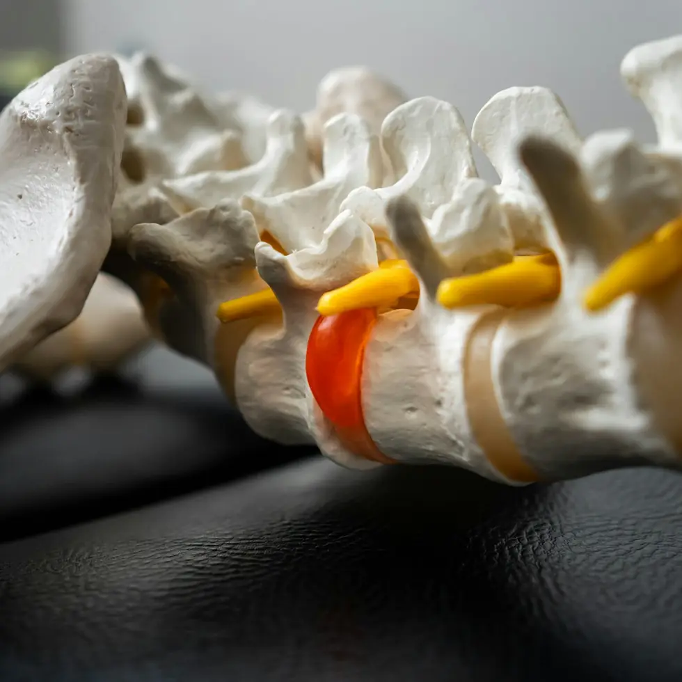 A model of the lower spine with one disc coloured red